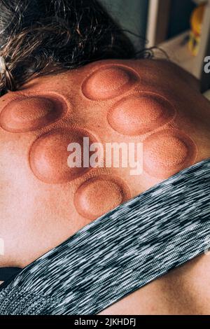 A vertical closeup of the cupping massage technique after removing cups Stock Photo