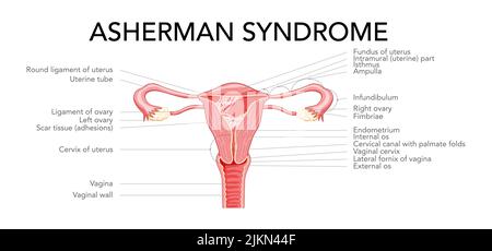 Syndrome d'Asherman le système reproducteur féminin cicatrice tissus adhérences dans l'utérus diagramme avec inscriptions. Vue de face dans une coupe. Schéma de localisation des organes internes de l'anatomie humaine, icône de type plat de l'ovaire du col de l'utérus Illustration de Vecteur