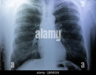 a closeup with x ray image of a human chest Stock Photo
