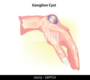 Kyste de ganglion sur la main Banque D'Images