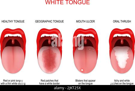 Lésion de la langue ou de la langue blanche. Comparaison de la langue saine et de la maladie buccale : langue géographique, ulcère de la bouche et muguet buccal. Affiche vectorielle à usage médical Illustration de Vecteur