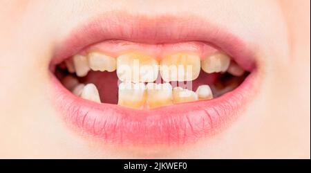 Gros plan sur les téths malsains de bébé. Patient enfant, bouche ouverte montrant des caries, carie dentaire. Mauvais dents enfant. Portrait garçon avec de mauvaises dents. Enfant souriez et Banque D'Images