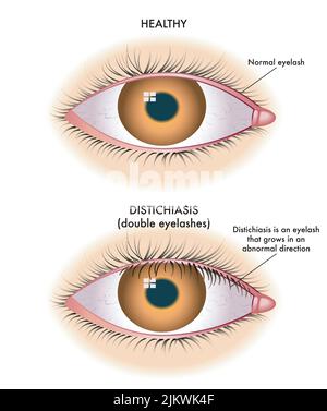 L'illustration médicale montre la comparaison entre un œil normal et un œil affecté par la distichiasis. Banque D'Images