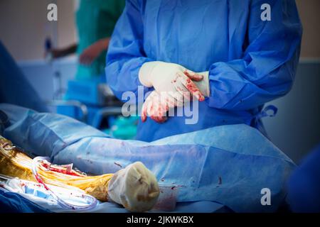 Salle d'opération de chirurgie orthopédique pour le retrait des fixations externes du tibia. Banque D'Images