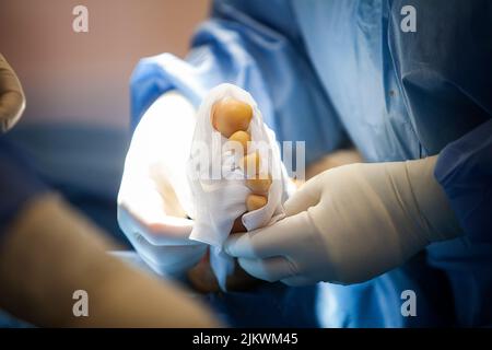 Chirurgie orthopédique, pansement après arthrodésie du gros orteil. Banque D'Images