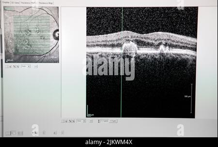 Tomographie par cohérence optique (OCT) montrant les débuts de la dégénérescence maculaire. Banque D'Images