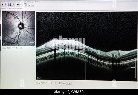 Tomographie par cohérence optique (OCT) montrant le nerf optique d'un patient à risque de glaucome. Banque D'Images