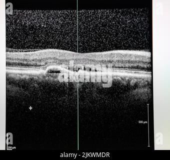 Tomographie par cohérence optique (OCT) d'un patient présentant un œdème maculaire. Banque D'Images