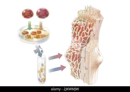 Greffe de cellules souches hématopoïétiques administrée pour coloniser la moelle osseuse. Banque D'Images