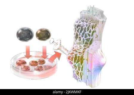 Greffe de cellules souches hématopoïétiques administrée pour coloniser la moelle osseuse. Banque D'Images