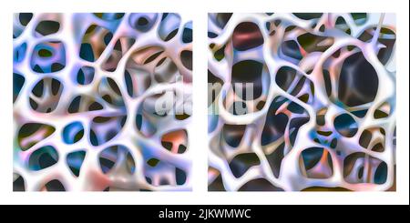 Comparaison entre l'os spongieux sain et l'ostéoporose. Banque D'Images