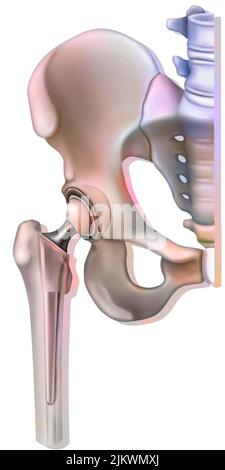 Système osseux : prothèse de hanche. Banque D'Images