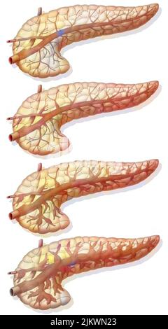 Évolution de la lésion du canal pancréatique. Banque D'Images