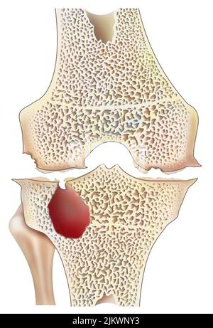 Genou avec arthropathie hémophile avec érosion articulaire marginale. Banque D'Images