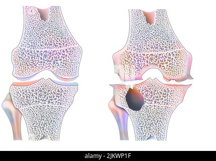 Genou en bonne santé avec arthropathie hémophile avec érosion articulaire marginale. Banque D'Images