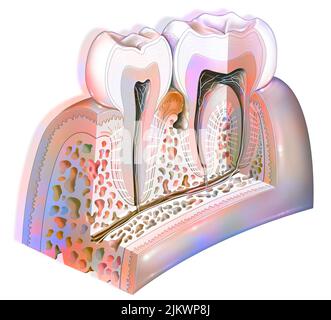 Plaque dentaire: Pathologies principales des dents: Tartre, gingivite. Banque D'Images