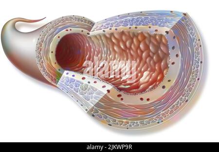 Maladie de Crohn : intestin grêle avec inflammation de la paroi. Banque D'Images