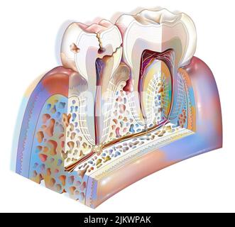 Plaque dentaire: Pathologies principales des dents: Tartre, gingivite, carie. Banque D'Images