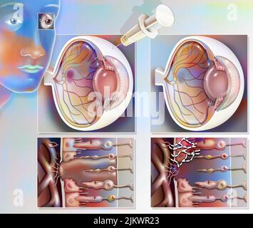 Traitement de la dégénérescence maculaire par injection d'interférence ARN. Banque D'Images