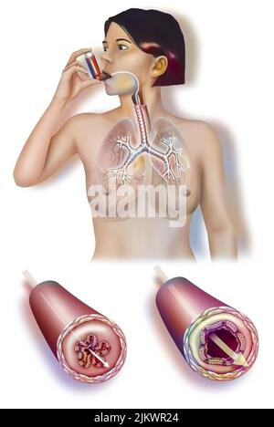 Femme prenant un inhalateur pour soulager une crise d'asthme avec un tube bronchique pendant et après l'attaque. Banque D'Images