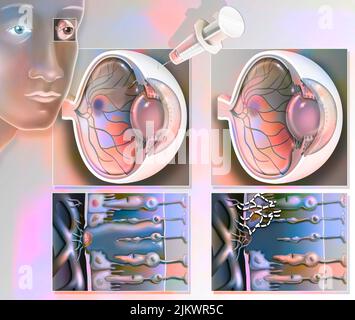 Traitement de la dégénérescence maculaire par injection d'interférence ARN. Banque D'Images