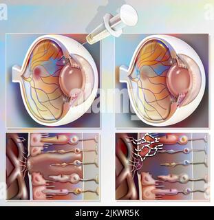 Traitement de la dégénérescence maculaire par injection d'interférence ARN. Banque D'Images