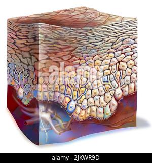 Coup de soleil au premier degré : les kératinocytes sont détruits. Banque D'Images