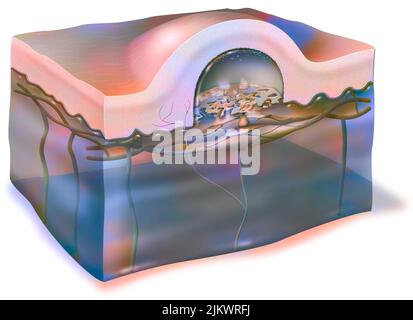 Phlyctène (plaquette thermoformée, plaquette thermoformée) : bulle sous la peau remplie de plasma. Banque D'Images