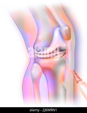 Articulation du genou, arthrographie : injection de produit de contraste pour rendre les structures visibles sur la radio. Banque D'Images