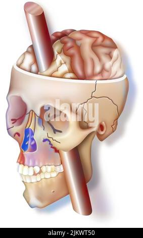 Le lobe frontal: Impact de la barre dans le crâne de Phineas Gage sur ses émotions. Banque D'Images