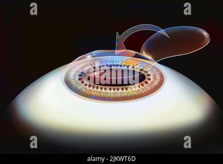 Oeil, chirurgie, Lasik étape 4: Le lambeau cornéen est remis en place. Banque D'Images