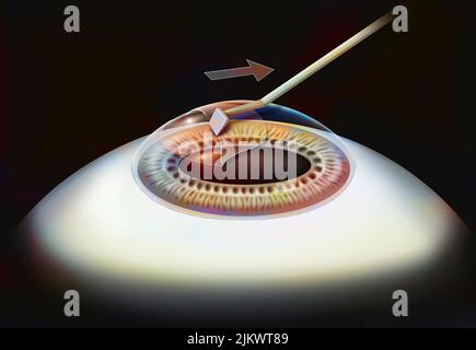 Oeil, chirurgie, Lasek étape 2: La couche de l'épithélium cornéen est détachée. Banque D'Images