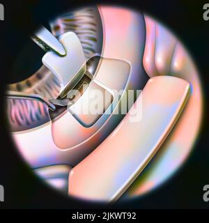 Oeil (glaucome): Sclérotomie avec ablation d'une petite partie du trabéculum. Banque D'Images