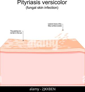 Pityriasis versicolor. Infection fongique de la peau. Coupe transversale d'une peau humaine avec des taches qui ne bronzent pas au soleil et des lésions qui ont une fine, flak Illustration de Vecteur