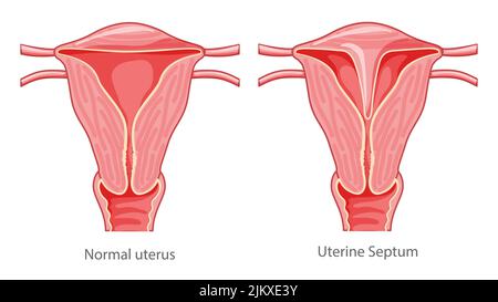 Ensemble de septum utérin utérus cloisonné diagramme du système reproducteur féminin normal et avec douleur de la maladie. Vue de face dans une coupe. Anatomie humaine organes internes icône plate Illustration médicale vectorielle isolée Illustration de Vecteur