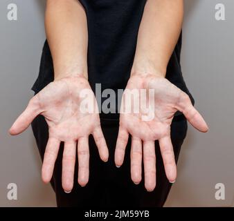 Eczéma dyshidrotique maladie de la peau sur les paumes contre fond blanc. Banque D'Images