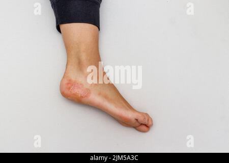 Eczéma dyshidrotique maladie de la peau sur le talon du pied contre fond blanc. Banque D'Images
