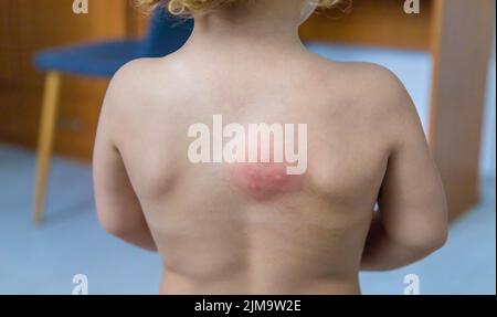 Piqûres de moustiques sur le dos d'un enfant. Mise au point sélective. Enfant. Banque D'Images