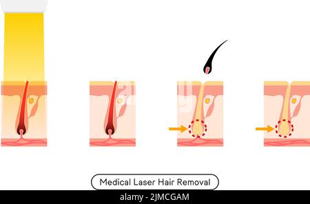 Image de l'enlèvement de cheveux, le processus de l'enlèvement de cheveux après le traitement médical d'enlèvement de cheveux de laser Illustration de Vecteur