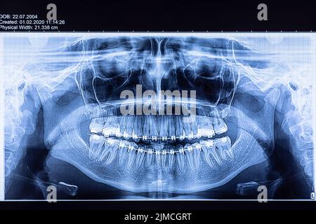 Radiographie dentaire avec bretelles Banque D'Images
