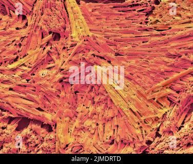 Cristaux d'acide urique dans la goutte, SEM Banque D'Images