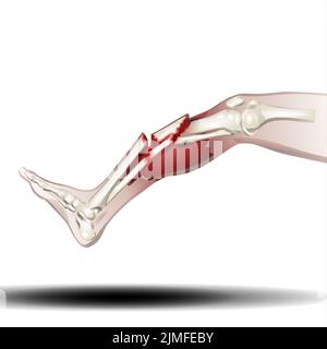 Fracture osseuse de la jambe - Illustration sur fond blanc Banque D'Images