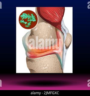 L'Arthrite septique Banque D'Images