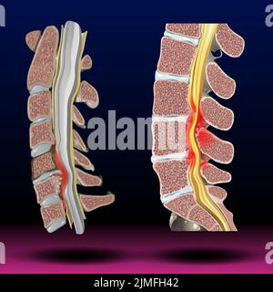 Sténose spinale Banque D'Images