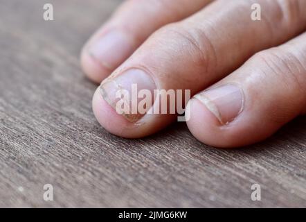 Ongles fragiles et endommagés de femme asiatique aînée. Infection fongique des ongles. Banque D'Images