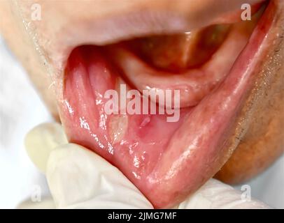 Ulcère aphteux ou ulcère de stress dans la bouche d'un patient asiatique mâle. Banque D'Images