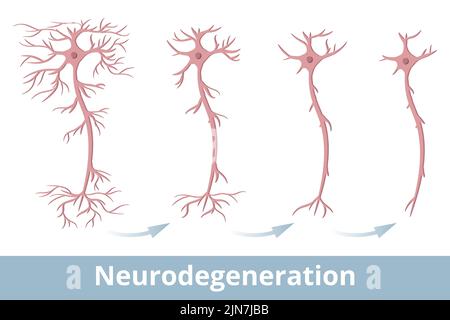 Neurodégénérescence. Dégénérescence d'une cellule nerveuse, qui se produit en raison de la sclérose en plaques, de la maladie de Parkinson, de la maladie d'Alzheimer Illustration de Vecteur