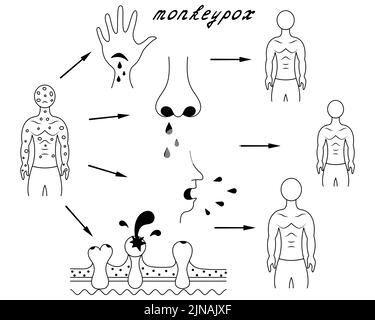 Méthodes d'infection humaine par la variole du singe. Schéma de la transmission de la variole de l'homme à l'homme. Esquisse. En contact avec des liquides organiques, peau endommagée Illustration de Vecteur