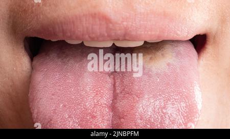 stomatite inflammation de la langue, cancer de la langue de près Banque D'Images