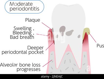 Illustration par étape de la maladie parodontale : parodontite modérée Illustration de Vecteur